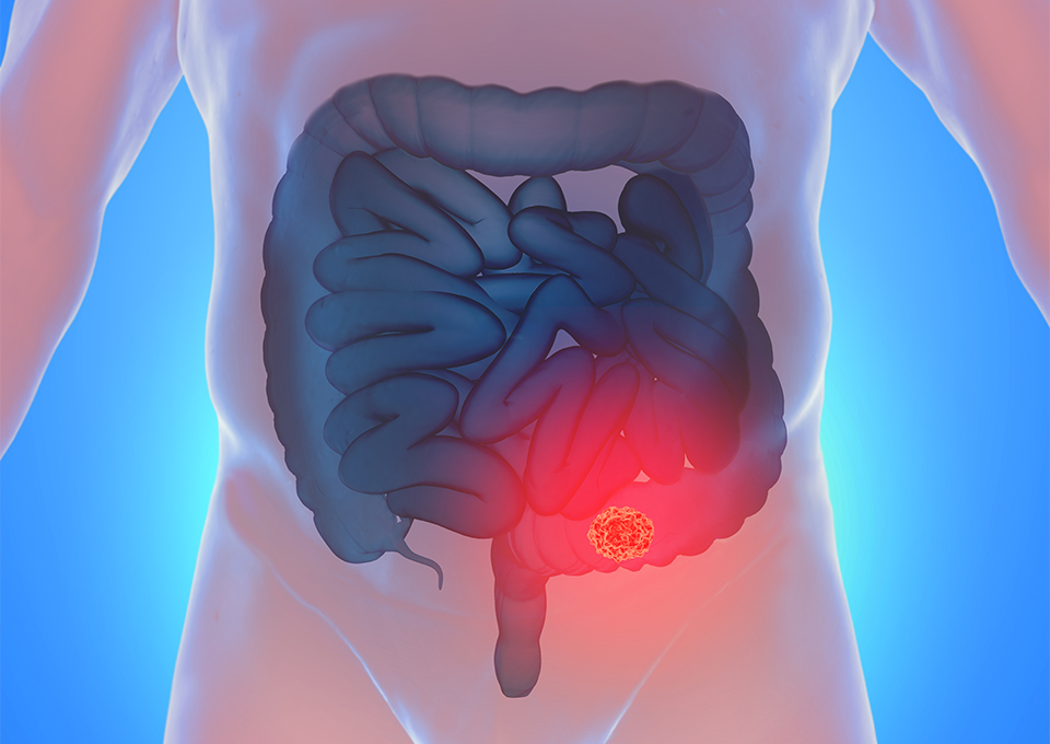 内視鏡検査で発見できる代表的な病気02_下部消化管内視鏡検査